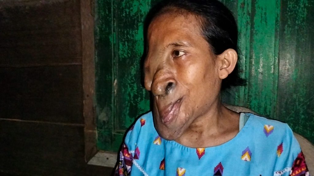 Diserang Tumor, Sukmaenah Butuh Bantuan Operasi Penormalan Wajah