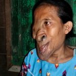 Penderita tumor