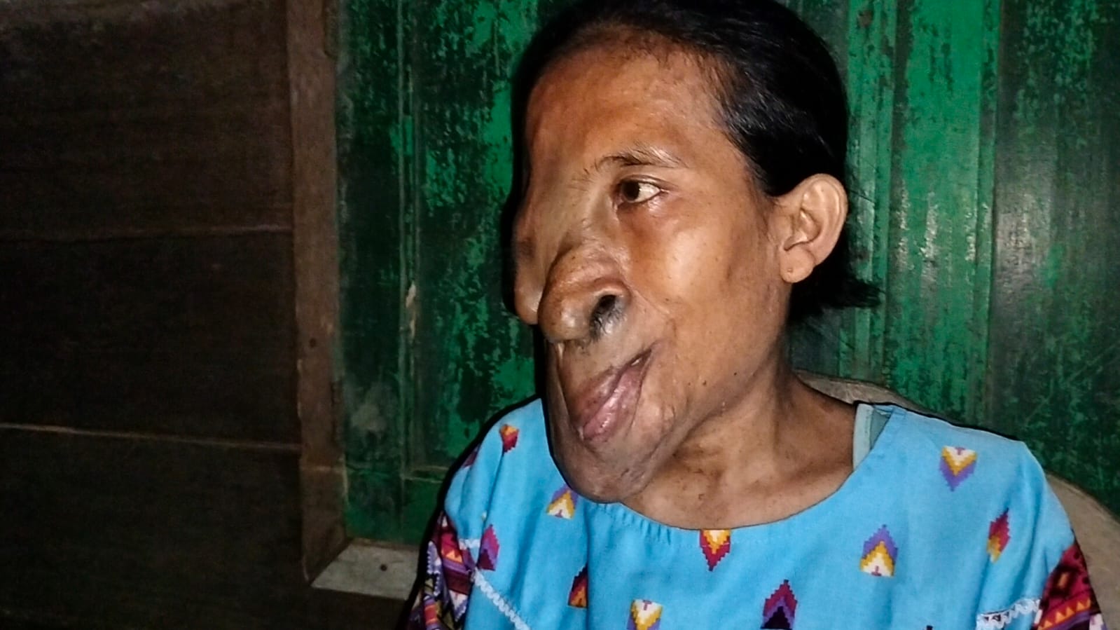 Penderita tumor
