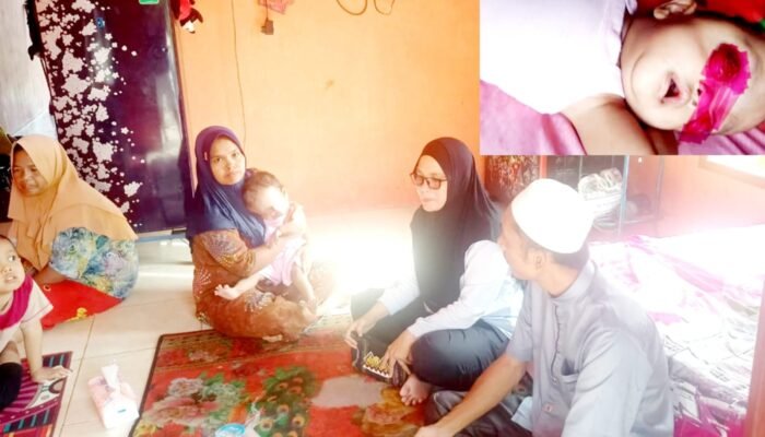 Balita Penderita Kanker Mata di Madina Butuh Uluran Tangan, Dinsos Lakukan Penjangkauan